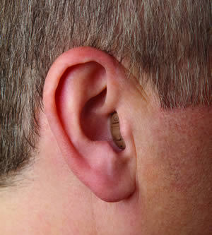 Completely In Canal Hearing Aid