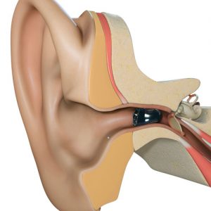 invisible-in-the-canal-hearing aid shown-in-ear