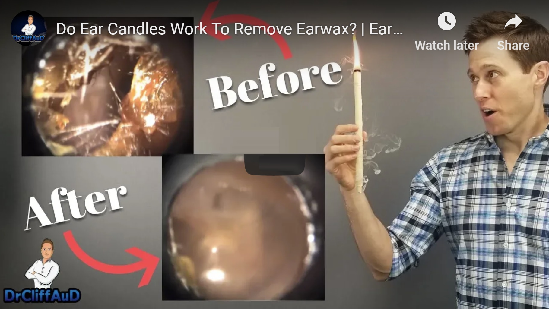 Read more about the article Do Ear Candles Remove Ear Wax?